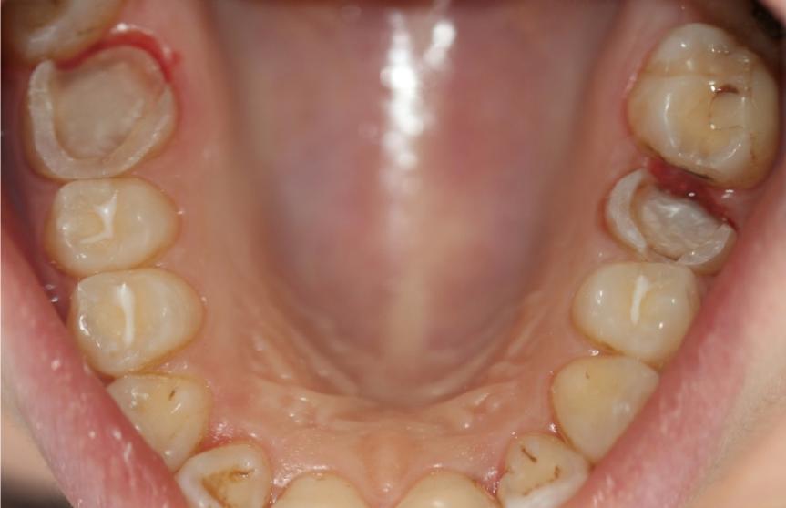 2 MPa, mesafe: 10 mm) pürüzlendirilmiş ve Variolink N dual cure siman (Ivoclar Vivadent, Schaan, Liechtenstein) ile simante edilmiştir.