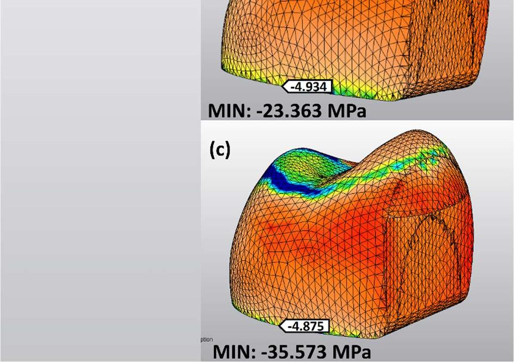 92 4.3.3. Restoratif Materyalde Oluşan Minimum Asal Stres Bulguları VMII ile restore edilen overley modelde FGK -5.970 MPa, VMII -24.856 MPa stres değerine sahiptir.