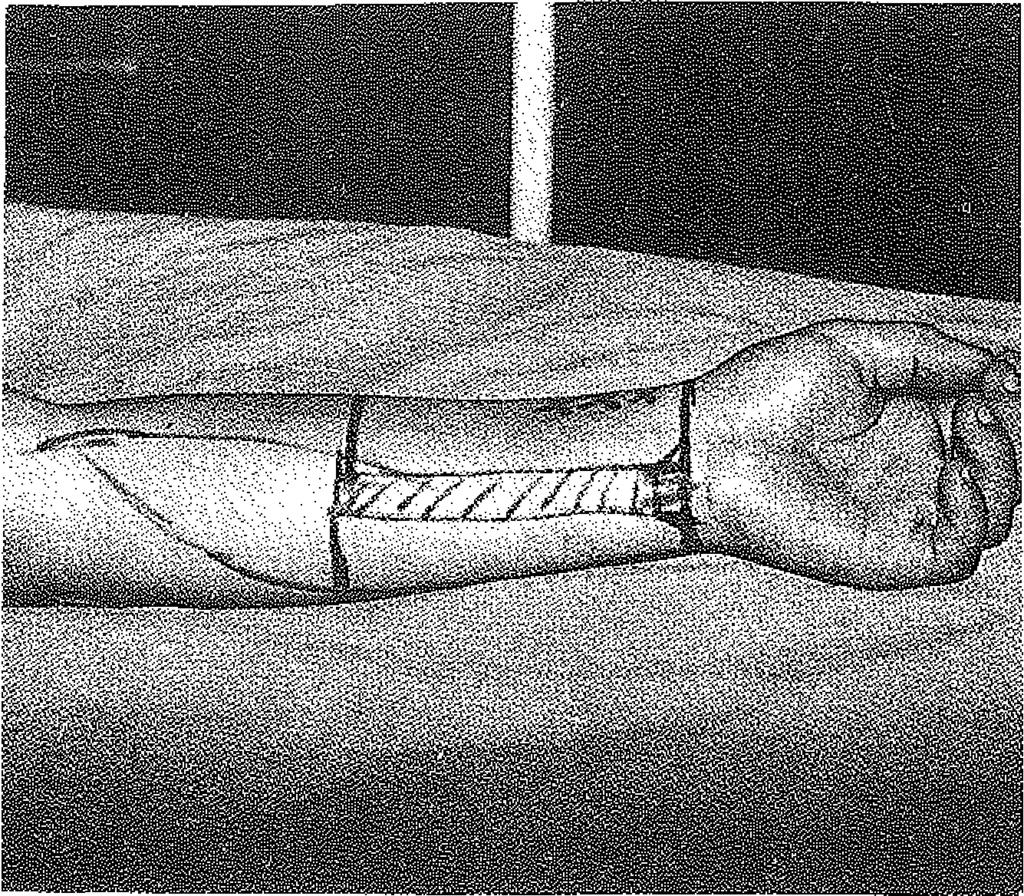 Ağrılı penis eıeksiyonu sonucu peniste ülserasyon ve nekroz gelişmesi üzerine penisi ampüte edilmiş olan ŞEKİL 5 : Birinci oluda penis şekline getirilen flebin görünümü hastaya ön koldan 13x14 cm.