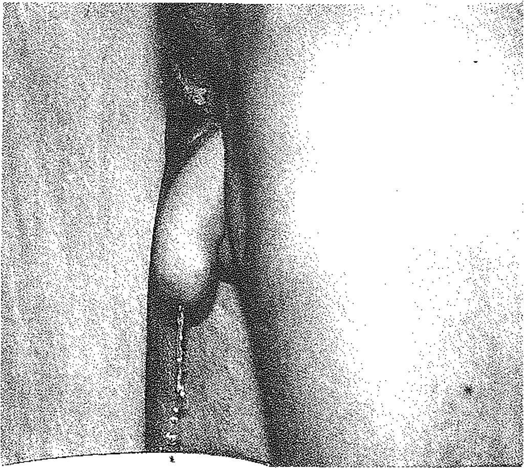 Penis şaftını oluşturan bölüm ise tüm bunları içine alacak tarzda tüp şekline getirilerek sütüre edildi. N.kutaneus antebraki Jateralisin anterior ve posterior dallan n.