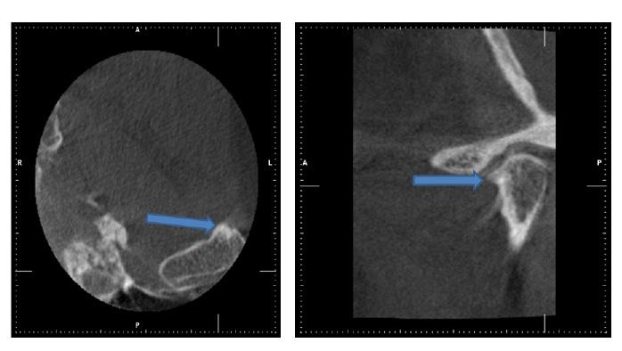Resim 6: KIBT yardımıyla dejeneratif eklem rahatsızlığı sonucu oluşan osteofitin görüntülenmesi (mavi oklar). (Vaka: Prof.Dr.
