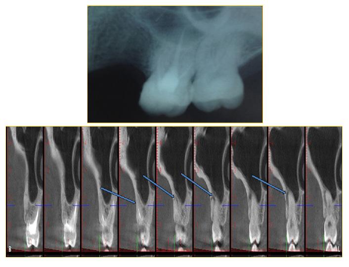 Resim 9: Periapikal radyografide herhangi bir periapikal patoloji saptanamayan klinik semptomlu kanal tedavisi yapılmış maksiller molar dişten elde edilen KIBT görüntüsünde eksik kanal tedavisi ile