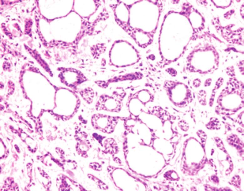 OLGU 13 Akciğerin Primer Adenoid Kistik Karsinomu 97 Resim 4: Adenoid kistik karsinom. Boşluklar içinde mukopolisakkarid içeren tübüler yapılar (H&E x200).