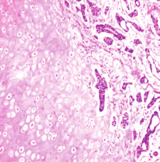 AKK lar tipik olarak trakea veya ana bronşlarda polipoid lezyonlar oluşturur ama uzunlamasına ve/ veya yatay yayılım gösteren infiltratif plaklar da yapar.