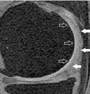 Uzun- TE FSE (4000/39) görüntüde (A) femur arka kondil düzeyindeki kıkırdak konturları net olarak seçilebilirken (ok başı) yağ baskılı 3D SPGR görüntülerde (B)