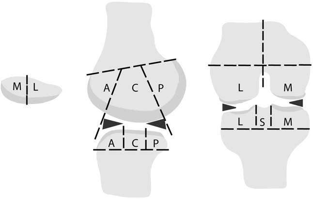 Şekil 3.1 Patella patellar tepe noktası sınır kabul edilerek medial faset (M) ve lateral faset (L) olarak ayrılmıştır. (1numaralı kaynaktan alınmıştır.
