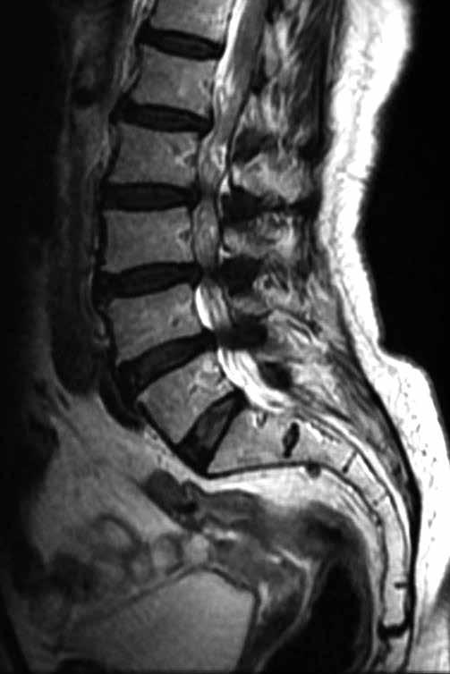 Daralmanın temel nedeni, yaşlı hastalarda daha sık görülmekte olan intervertebral disk ve ligamentum flavum gibi omurga bileşenlerinin dejenerasyonuyla birlikte oluşan basıdır.