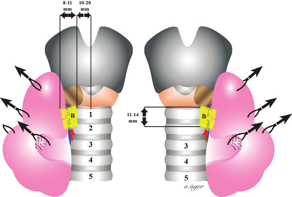 [15] RLS nin en sık bu anatomik yapı nedeniyle yaralandığı unutulmamalıdır.