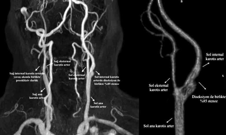 İnternal karotis arter diseksiyonu 155 (a) (b) Şekil 1. Manyetik rezonans anjiyografide saptanan karotis arter hastalığı. (a) Sağ internal karotis arterde yavaş akımla birlikte preokluziv darlık.