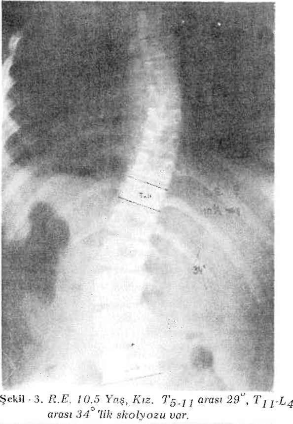 1970 yılında Moe ve Kettleson (11) 169 hastada Milwaukee b rey si ile yaptıkları tedavi sonuçlarım yayınladılar.