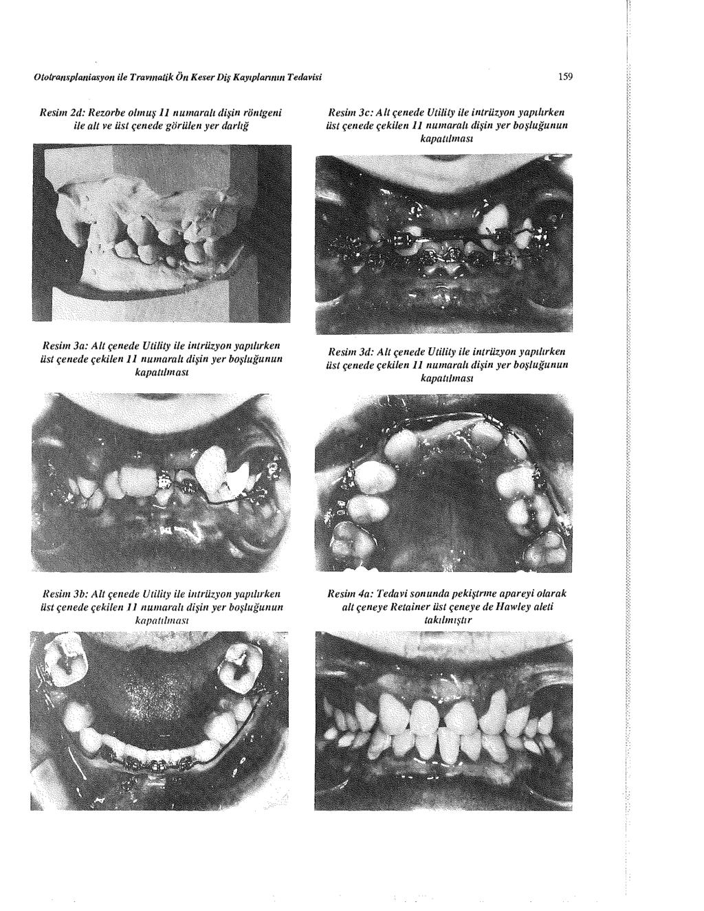 Ototransplaniasyon ile Travmatik Ön Keser Diş Kayıplarının Tedavisi 159 Resim 2d: Rezorbe olmuş 11 numaralı dişin röntgeni İle alt ve üst çenede görülen yer darlığ Resim 3c: Alt çenede Vtİlity ile