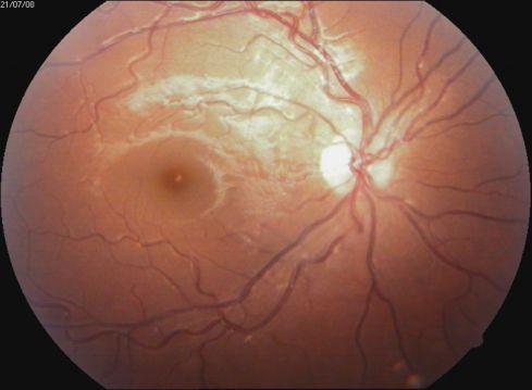 OPTİK NÖRİT Optik nörit ya da optik sinirin primer inflamasyonu, optik disk şiştiğinde papillit ve optik disk normal göründüğünde, retrobulber nörit olarak adlandırılır (Şekil-6).