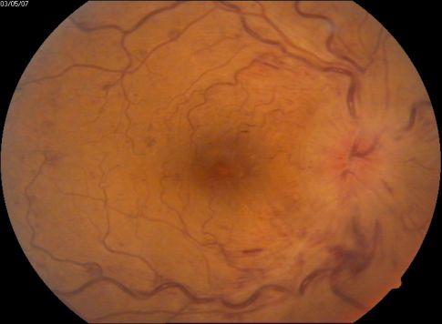 Şekil 8: SRVO lu bir olguya ait renkli fundus fotoğrafı. Noniskemik SRVO SRVO hastalarının % 75-80 i noniskemik SRVO dur.