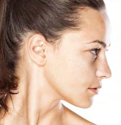 PRP UYGULAMA alanları Sivilcelere bağlı olarak oluşan yüzeyel ve derin çukurcuklar (akne izleri) ile kahverengi lekelerin giderilmesi Genişlemiş gözeneklerin sıkılaştırılması Güneş lekeleri (yüz ve