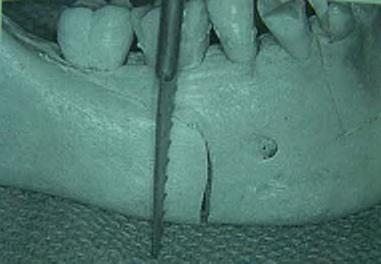 13 Osteotomiler tamamlanıp mandibula tamamen serbestlendiği zaman önceden hazırlanmış akrilik splint sayesinde maksilla ve mandibula normal oklüzyonda sabitlenir.