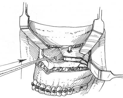 yapılmasına engel olan kemik ve kıkırdak yapılar rezeke edilir. Okluzal splint yardımıyla maksilla ve mandibula uygun oklüzyonda birbirine tespit edilir.