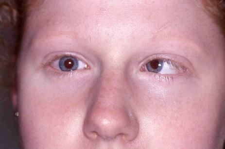 13-2 ye bakınız). Normal hareket edebilen diğer gözü ise, Duane Sendromu olan göze doğru atılır gibi görünebilir ve böylece kayıyormuş gibi gözükebilir.