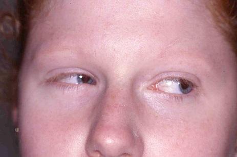 A B C D Şekil 13-2 Bu kızın sağ gözünde Duane Sendromu mevcuttur. B) Direkt karşıya baktığında gözleri düzgün hizadadır. A) Sağına baktığında, sağ gözü orta hattaki pozisyonunu geçip hareket etmez.