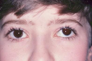 Bazı çocuklarda bu her zaman bir gözüdür, bazılarında ise iki göz arasında değişkenlik gösterebilir.