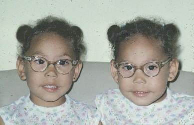 A B Şekil 4-3 A) Bu iki kız çocuğu tıpa tıp aynı tek yumurta ikizleridir. Fotoğraftaki soldaki ikizin sağ gözünde içe kayma mevcuttur. Fotoğrafta sağdaki kızkardeşinin ise sol gözü içe kaymaktadır.