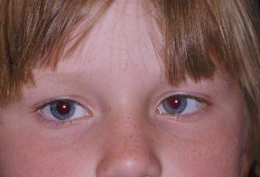A B Şekil 6-2 A) Sol gözünde içe kayması olan bir kız çocuğ unu göstermektedir. B) Eğ er sağ gözünü kapatıp sol gözü ile baktırırsanız, sol gözü düz hale gelir.