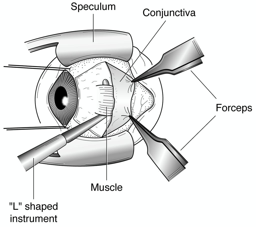 Şekil 7-1 Bir sağ gözün bu görüntüsü bir oftalmolugun şaşılık cerrahisi sırasında göreceğine çok benzer. Gözkapakları bir spekulum ile nazikçe birbirinden ayrık tutulur.
