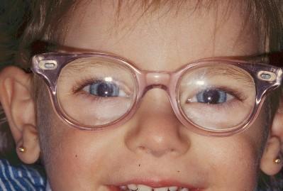 Bölüm 10 Şaşılığa Yaklaşımda Gözlükler Temel Bilgi Genç Çocuklar için Gözlükler: Gözlüklerin kullanımının şaşılık tedavisinin önemli bir parçası olduğunu öğrendiniz.