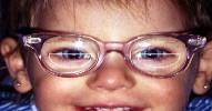 Şekil 10-2 Esotropyası olan bir çocukta bifokalin uygun yerleşimi. Bifokal çizgisi pupil-ortasındaki seviyededir. Soru: Doktorumuz 3 yaşındaki kızıma esotropya tedavisi için bifokal gözlük önerdi.