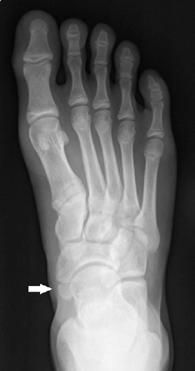 Çocuklarda ayağın radyografik değerlendirmesi 391 Şekil 1. 14 yaşındaki bir olguda os navikülare (beyaz ok) görünümü. Şekil 2. 12 yaşındaki bir olguda os trigonum (beyaz ok) görünümü.