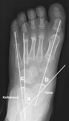 Çocuklarda ayağın radyografik değerlendirmesi 393 seyreder (Şekil 4). Talus 1. metatars arası açı ölçümünde olduğu gibi ayak arkası ile ayak önü dizilimlerinin kıyaslanmasını sağlar.