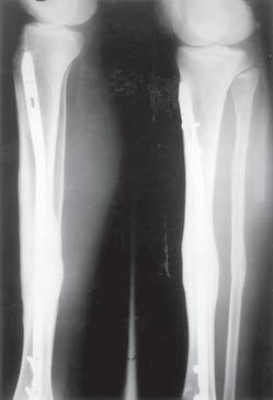 Anterior knee pain after intramedullary týbial nailing. Changgeng Yi Xue Za Zhi 1999; 22-4: 604-608. 6. Tropet Y, Garbuio P, Obert L, Ridoux PE. Emergency management of typ3b open týbial fractures.