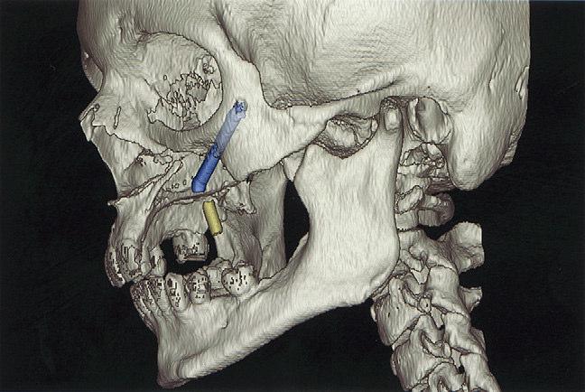 yerleştirmek için yeterli kemik olmadığı durumlarda sadece bilateral zigomatik implantlarla da tedavi edilebilirler 18,19. 2.