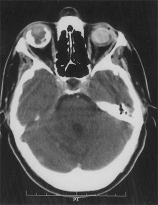 Resim 2. Kontrastlı BT kesiti, sağ orbitada kontrast tutan hemanjiyoblastom ile uyumlu vasküler malformasyon ve sağ serebellar hemisferdeki kontrast tutan hemanjiyoblastom görülüyor.