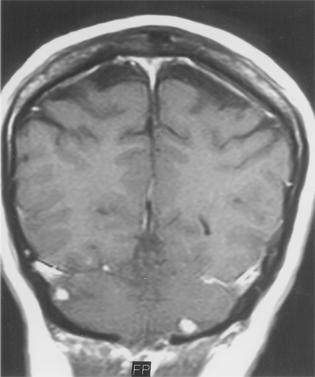 Retinal ve serebellar hemanjiyoblastomalar hastalığın en sık görülen komplikasyonlarını oluşturup olguların %59 unda görülür.