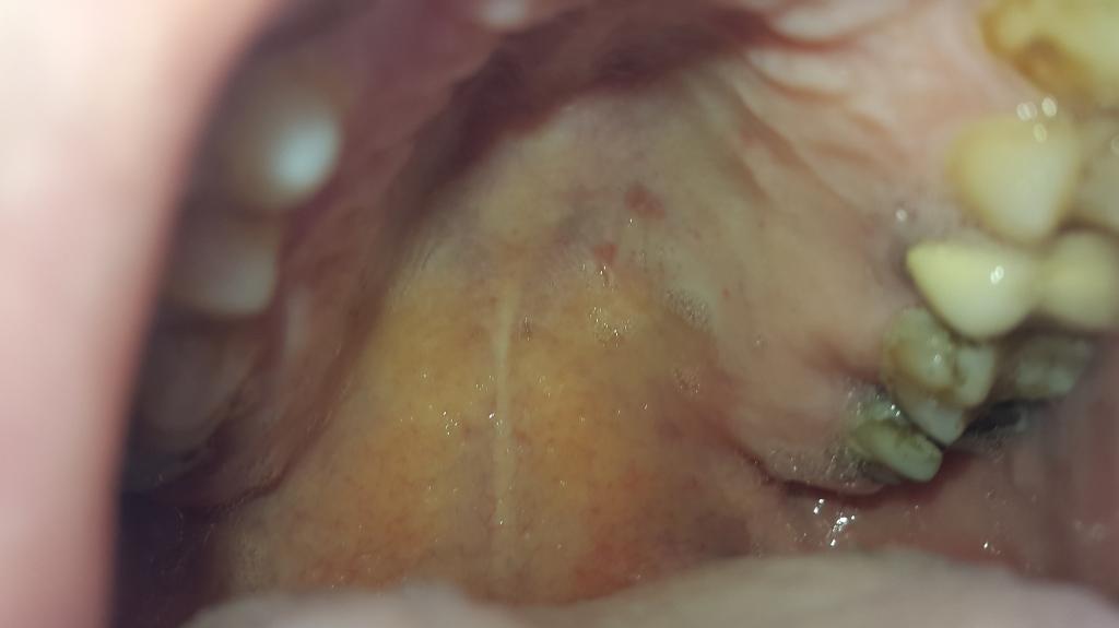 In November 2014, A 39-year-old Turkish male was admitted to our clinic with fever, sore throat, malaise and multiple vesicles on both palms and soles for a