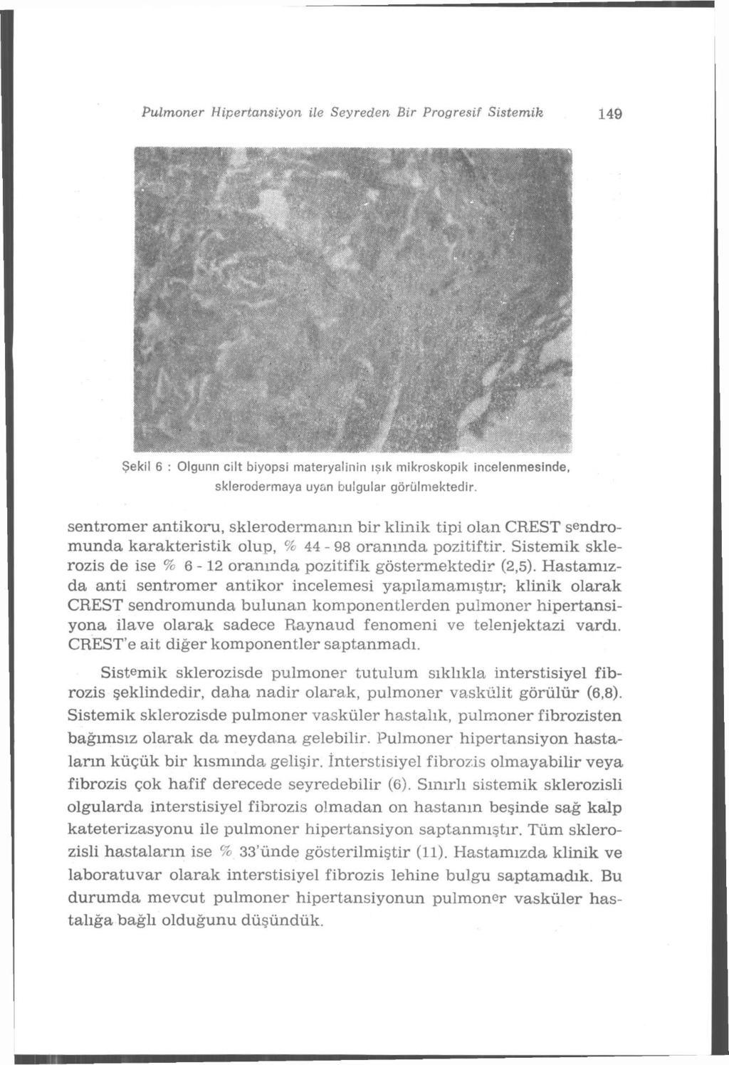Pulmoner Hipertansiyon ile Seyreden Bir Progresif Sistemik 149 Şekil 6 : Olgunn cilt biyopsi materyalinin ışık mikroskopik incelenmesinde, sklerodermaya uyan bulgular görülmektedir.