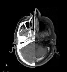 Şekil 7.1: BT ve MRI görüntüsünün aynı ortamda birleştirilmesi. 7.1 Baş Boyun Tümörleri ve Füzyon MRI, baş-boyun tümörleri tanı ve evrelemesinde rutin kullanılan bir yöntemdir.