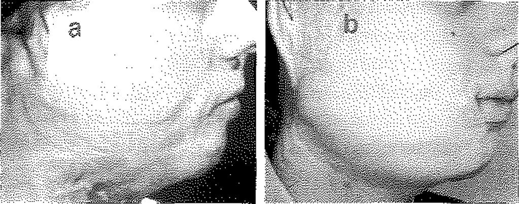 Şekil3A: Öncesinde tensor fasya lata transpoze ediien karın önduvarı yanağının ameliyat öncesi görünümü B: Hastanın se rb e st skapuiar flep transfer edildikten 18 ay sonraki görünüm ü Olgu 1 : Otuz