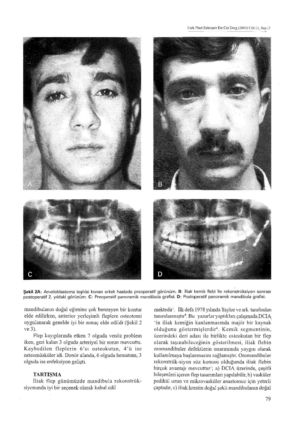 Türk Plast Rekoııstr Est Cer Derg (2003) Cilt: 11, Sayı:2 Şekil 2A: Ameloblastoma teşhisi konan erkek hastada preoperatif görünüm, B: İliak kemik flebi ile rekonstrüksiyon sonrası postoperatif 2,