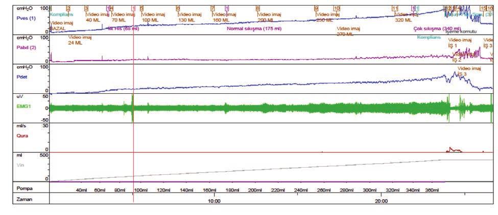 174 BÖLÜM 20 Pediatrik Hasta Grubu Ürodinami Örnekleri İşeme süresi: 79 s Gecikme süresi: 10 s Ortalama akış hızı: 1.