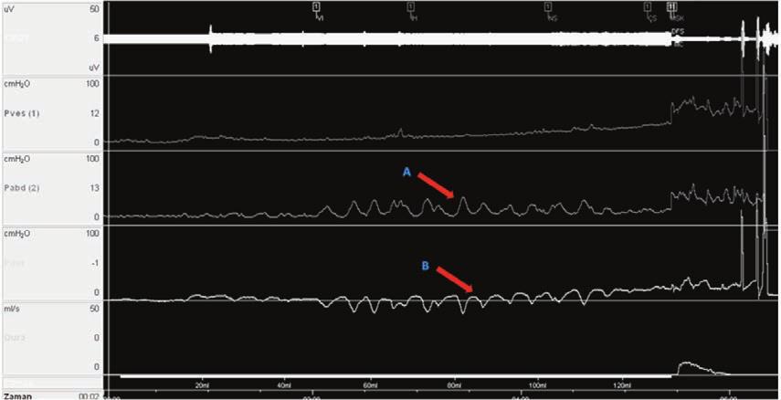 76 BÖLÜM 9 Artefaktların Yorumlanması Şekil 7. Hastanın rektumunu sıkması sonucunda oluşan ve vezikal basınca yansımayan rektal kontraksiyon dalgalarının görünümü (A).