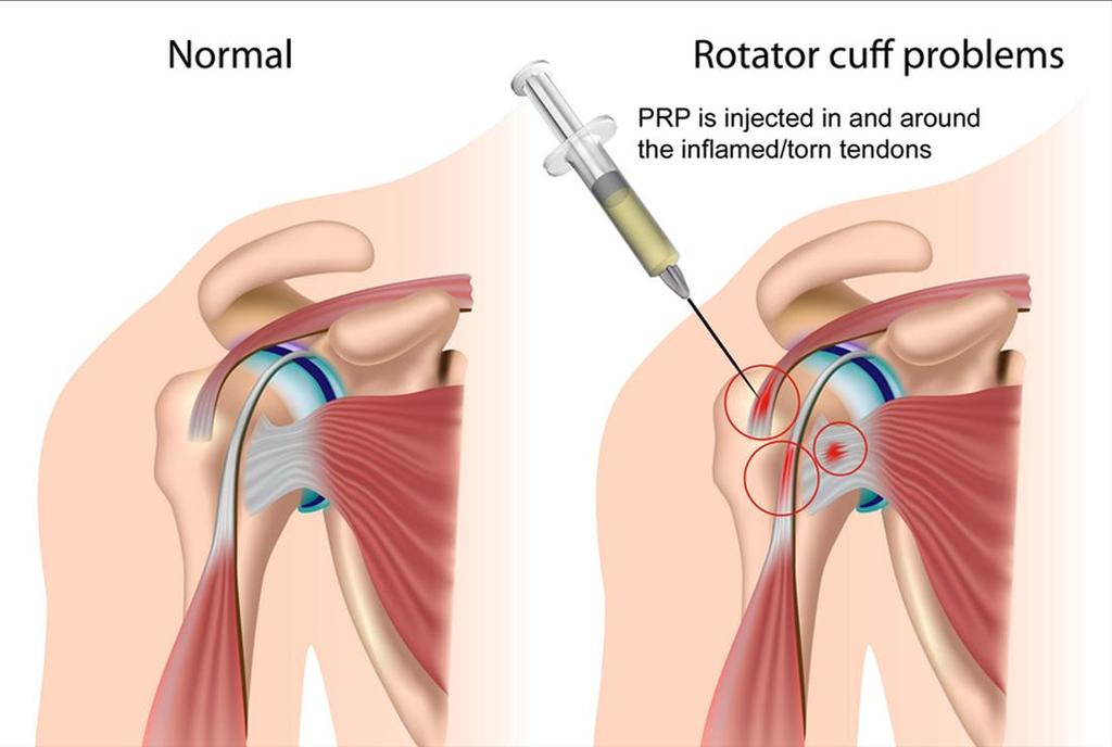 Rotator cuff