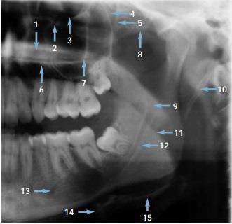 1. Sert damağın gölgesi 2. Lakrimal kanal 3. İnferior orbital marjin 4. Pterygopalatin fissur 5. Lateral pterygoid plate antrum 6. Sert damak 7. Zigomatik buttress 8.