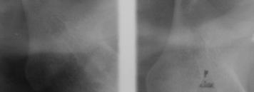 Hastanın; tedavi öncesi röntgenleri (Resim 82), normal