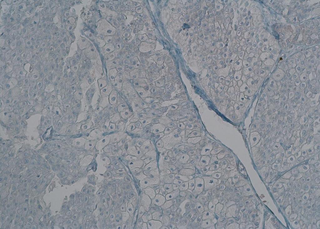 kromofob renal hücreli karsinom olgusu (Biyopsi No: 2568/15)