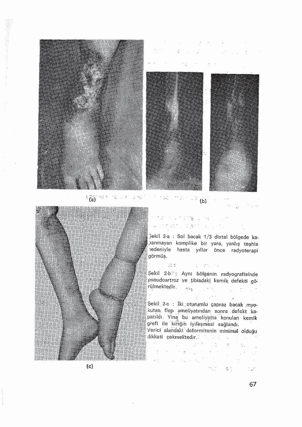 ?ekri 2-a : Sol bacak 1/3 distal bölgede kapanmayan komplike bir yara, yanlış teşhis