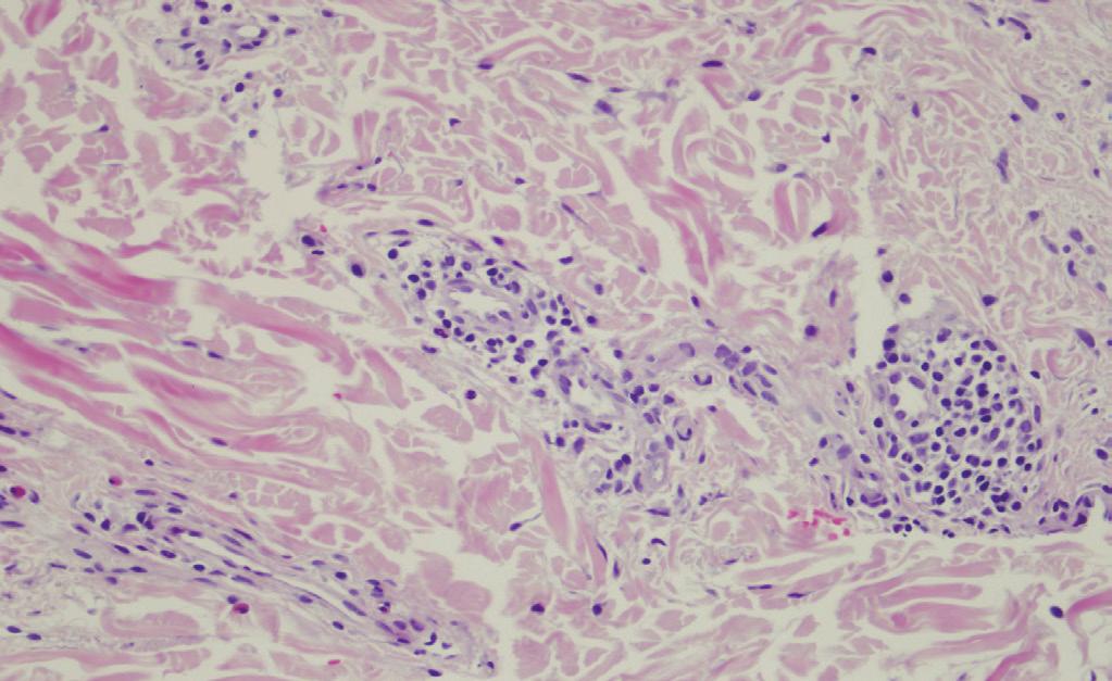 herpetiformis, eritema annulare sentrifigum, prurigo simpleks ve ürtikeryal dermatit ön tanıları ile punch biyopsi alınmıştı.