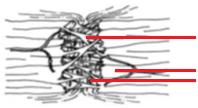 Tenositler yavaş yavaş yaraya göç eder ve tip 3 kollajen sentezi başlar (38) (Şekil 4). Proliferatif Evre Bu safhada disorganize bir doku olan granülasyon matriksi yara alanında boy gösterir.