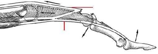 A Santral Slip Anteriora Yer Değiştiren Lateral Bant Lateral bantlar Dorsal e kaydırılıp birbirine sütüre edilerek PIP ekstansörü olması sağlanıyor Oblik Retinakuler Ligamanı C Şekil 9.