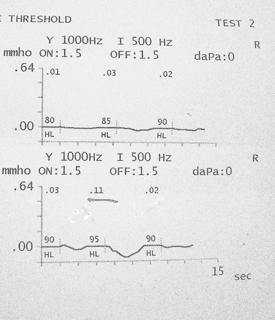 değerlendirme yapılarak bireylerin akustik immitansmetri parametrelerinden timpanometrik tepe basıncı (TTB), admitans ve eşdeğer kulak kanalı volümleri ölçülmüştür.